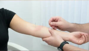 טיפול דיקור בפוסריאזיס